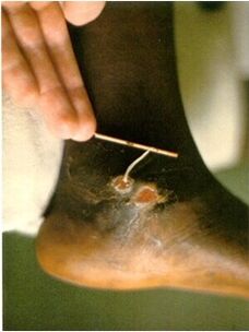 Guinea worm taken from the leg of a person suffering from dracunculiasis
