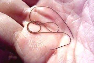 parasitic worms from the human body